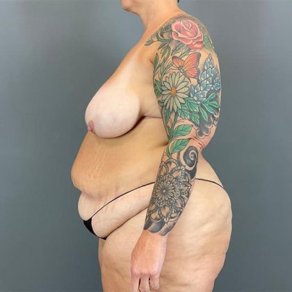 Breast Reduction Before & After Patient #1826