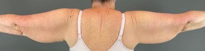 Arm Lift Before & After Patient #219