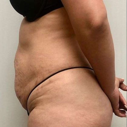 Tummy Tuck Before & After Patient #379