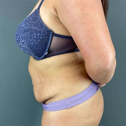Tummy Tuck Before & After Patient #390