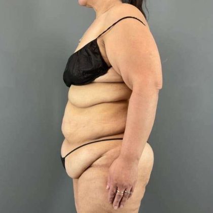 Tummy Tuck Before & After Patient #401