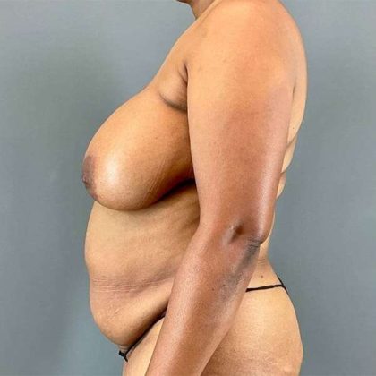 Tummy Tuck Before & After Patient #412