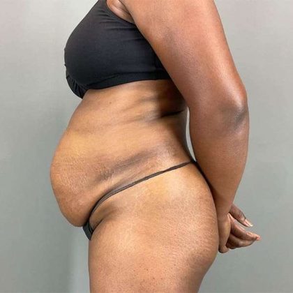 Tummy Tuck Before & After Patient #423