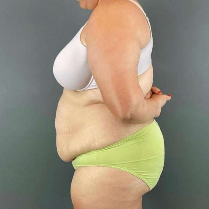 Tummy Tuck Before & After Patient #434