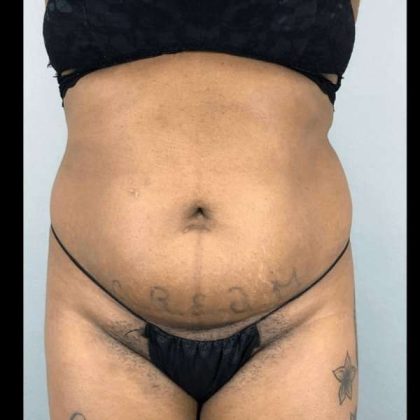 Tummy Tuck Before & After Patient #454