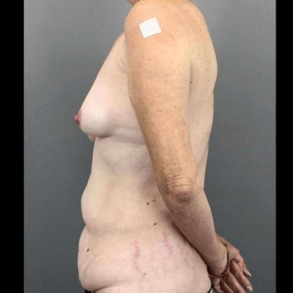 Tummy Tuck Before & After Patient #465