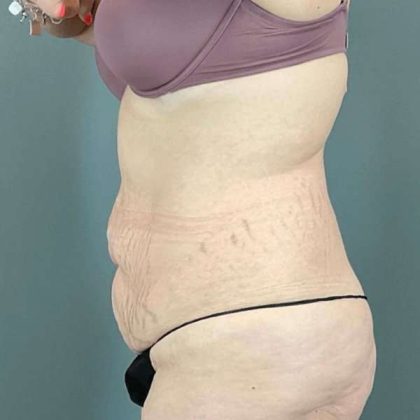 Tummy Tuck Before & After Patient #476