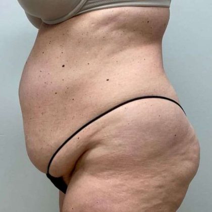 Tummy Tuck Before & After Patient #498