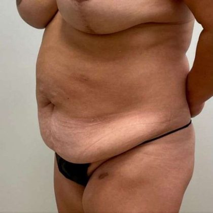 Tummy Tuck Before & After Patient #509