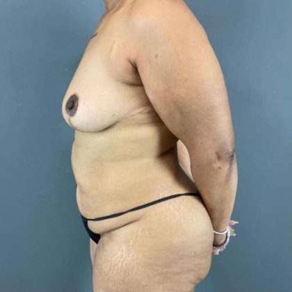 Tummy Tuck Before & After Patient #542
