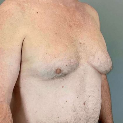 Gynecomastia Before & After Patient #571