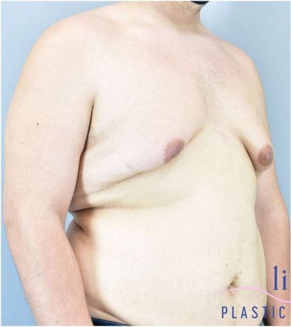Gynecomastia Before & After Patient #582
