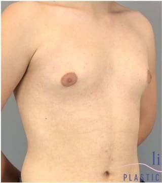 Gynecomastia Before & After Patient #593