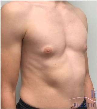 Gynecomastia Before & After Patient #604