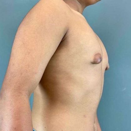 Gynecomastia Before & After Patient #622