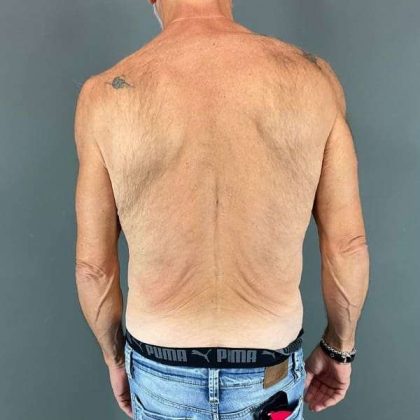 Gynecomastia Before & After Patient #642