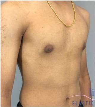 Gynecomastia Before & After Patient #653