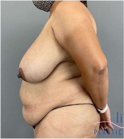 Breast Reduction Before & After Patient #664