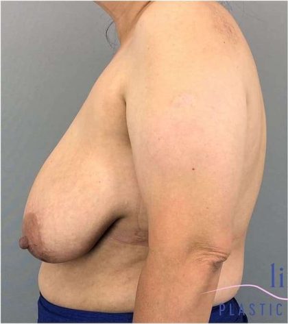 Breast Reduction Before & After Patient #675