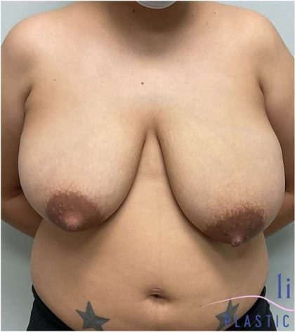 Breast Reduction Before & After Patient #697