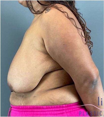 Breast Reduction Before & After Patient #708
