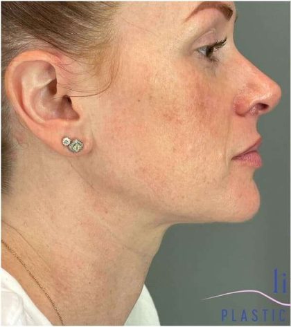 Injectables&Fillers Before & After Patient #118