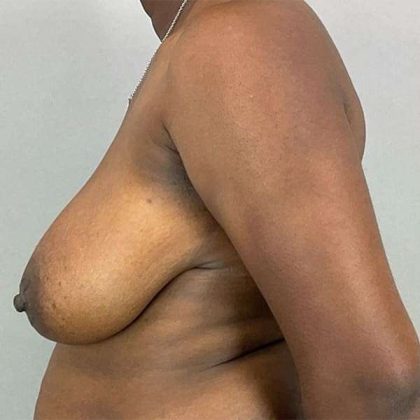 Breast Reduction Before & After Patient #730