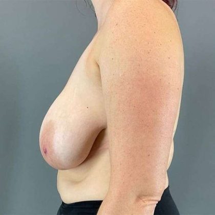 Breast Reduction Before & After Patient #741
