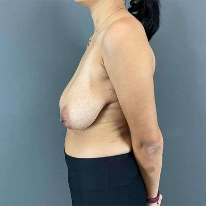 Breast Reduction Before & After Patient #752