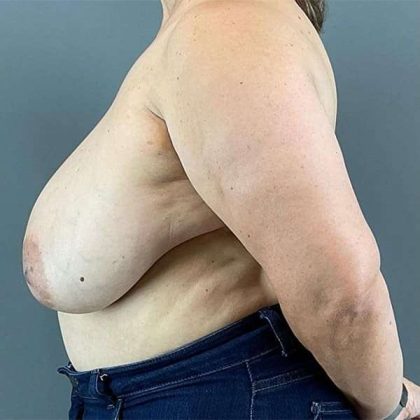 Breast Reduction Before & After Patient #763