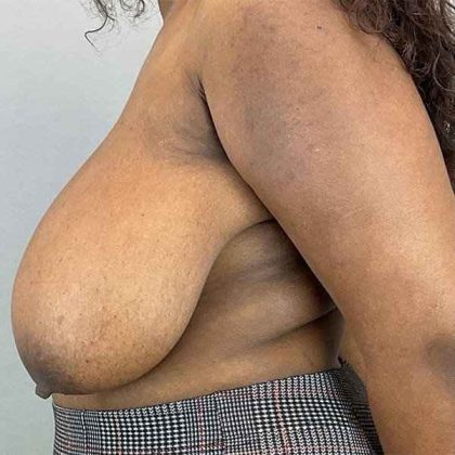 Breast Reduction Before & After Patient #774