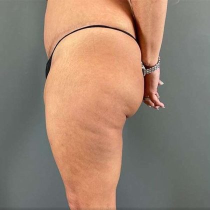 Thigh Lift Before & After Patient #233