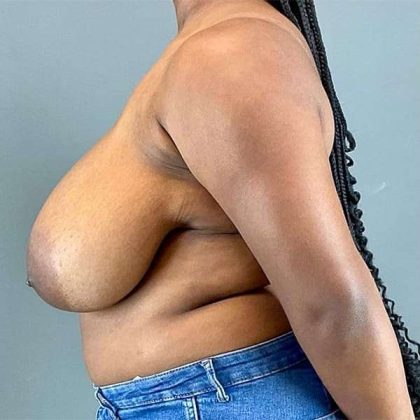 Breast Reduction Before & After Patient #810