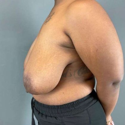 Breast Reduction Before & After Patient #828