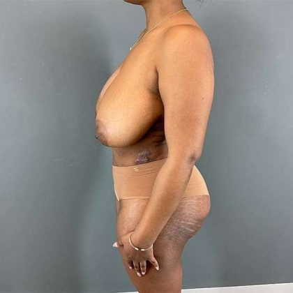 Breast Reduction Before & After Patient #839