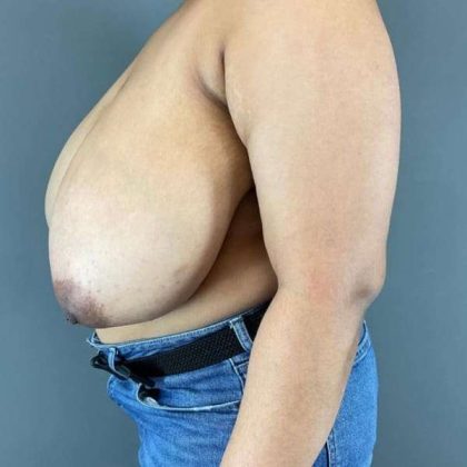 Breast Reduction Before & After Patient #850