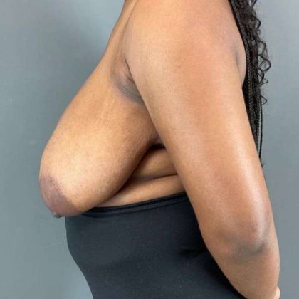 Breast Reduction Before & After Patient #861