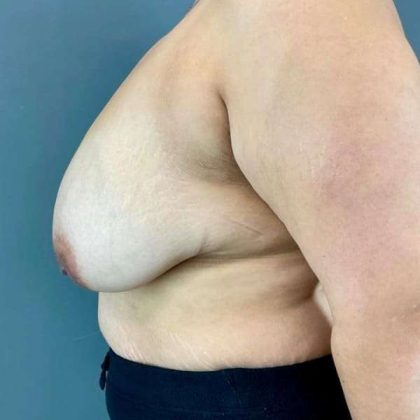 Breast Reduction Before & After Patient #872