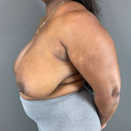 Breast Reduction Before & After Patient #883