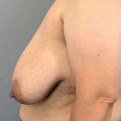 Breast Reduction Before & After Patient #894