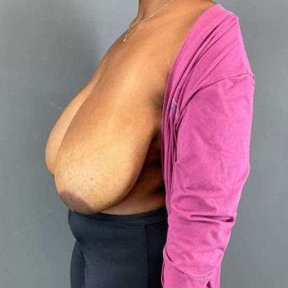 Breast Reduction Before & After Patient #905