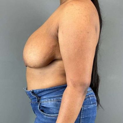 Breast Reduction Before & After Patient #916