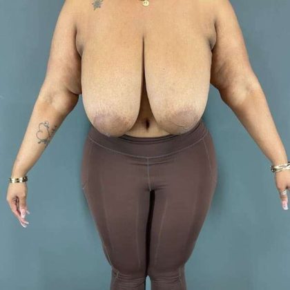 Breast Reduction Before & After Patient #927