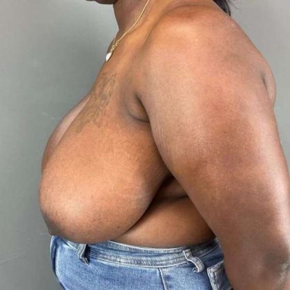 Breast Reduction Before & After Patient #938
