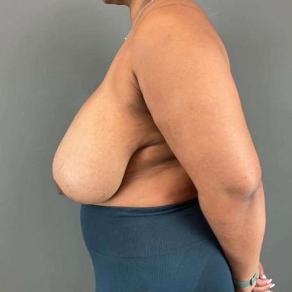 Breast Reduction Before & After Patient #967