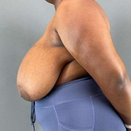 Breast Reduction Before & After Patient #978