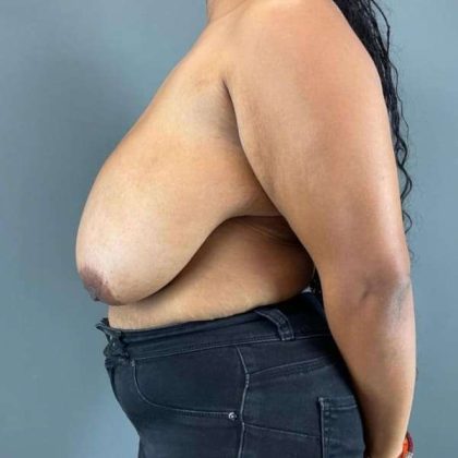 Breast Reduction Before & After Patient #998