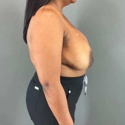 Breast Reduction Before & After Patient #1007