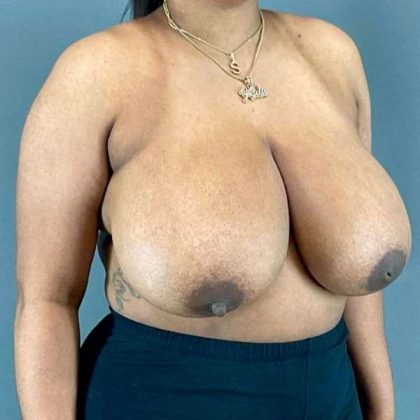 Breast Reduction Before & After Patient #1018