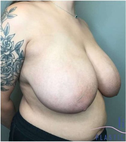 Breast Reduction Before & After Patient #1029